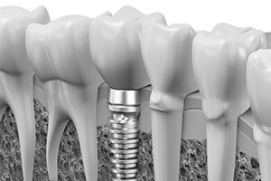 up close dental image of molars 