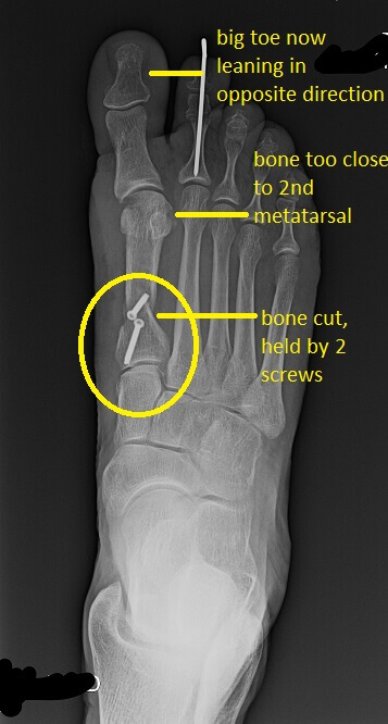 Second of three x-rays of a patient's foot post-operation