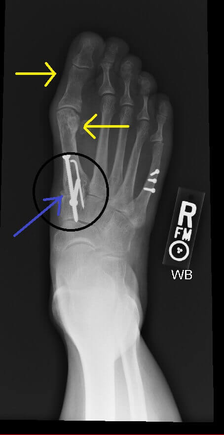 Third of three x-rays that show hallux varus worsening.